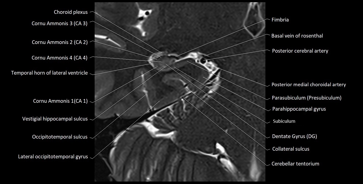 Hippocampus anatomy mri coronal cross section 3T MRI image 10.webp